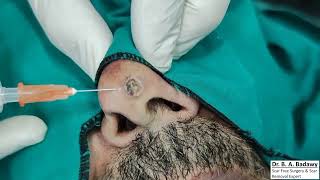 Scarless Nasal mole removal [upl. by Ettenal]