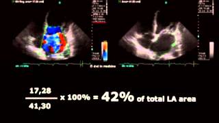 Volodymyr Pavliuk MD PhD Echocardiographic Assesment of Mitral Regurgitation [upl. by Englebert]