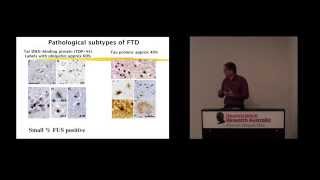 Frontotemporal dementia an overview [upl. by Nauqed]