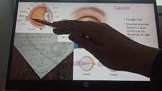 etiological classification of myopia part 3 BYNG MEDICALS [upl. by Enihpad]