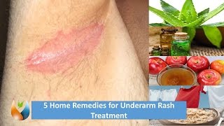 5 Home Remedies for Underarm Rash Treatment [upl. by Adnahs]