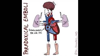 Embolic Events Stroke vs PE vs Paradoxical Emboli [upl. by Latsyk413]