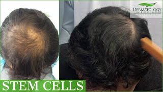 STEM CELL  PRP Therapy for Hair Loss with THREE MONTH UPDATE [upl. by Inverson]