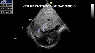 Carcinoid Disease Echocardiography [upl. by Haroldson]