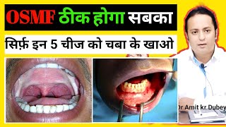 OSMF Treatments in Ayurvedic  5 Ayurvedic उपचार । dramitkdubey [upl. by Romeu357]