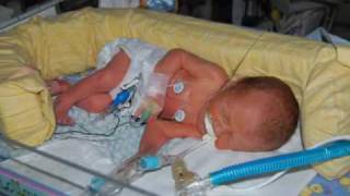 32 week Preemie Samuels Month in NICU and Year [upl. by Michaella]