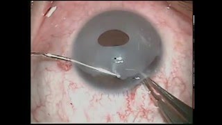 Eye Color Change New iris Implant removal exhanged to Brightocular [upl. by Rosenstein]