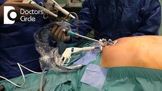 How long does it take to recover from Laparoscopic Surgery  Dr Beena Jeysingh [upl. by Naryb755]