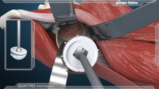 Anterior Approach amp Dual Mobility Acetabular Component 3D Animation [upl. by Nerret736]