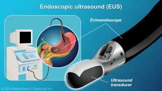 Understanding EUSFNA [upl. by Therron]