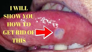 how to get rid of canker sores on tongue canker sores in mouth treatment [upl. by Ahseuqram]