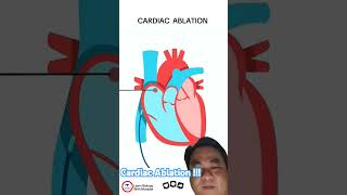 Cardiac Ablation [upl. by Ennaeus]