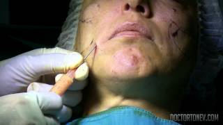 Липофилинг на лице  др Антон Тонев Face Lipofilling [upl. by Thar]