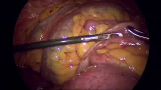 Laparoscopic management of Adhesive Band small bowel obstruction [upl. by Eruot]