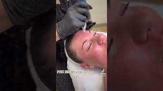 The No Peel Pain Free No Downtime Skin Treatment PRX [upl. by Yleoj]