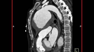 MDCT 64 Aortic Aneurysm Sagittal View [upl. by Oinegue721]