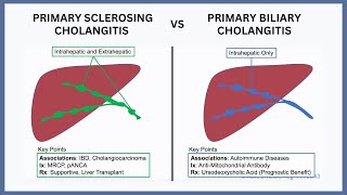 Primary Biliary Cholangitis vs Primary Sclerosing Cholangitis [upl. by Armelda]