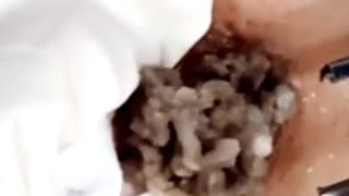 Popping huge blackheads and Pimple Popping  Best Pimple Popping Videos 112 [upl. by Artair765]