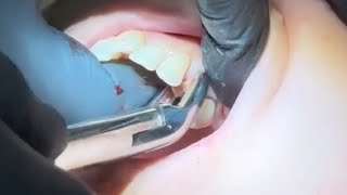 Extraction for First Maxillary Premolar [upl. by Kyre723]