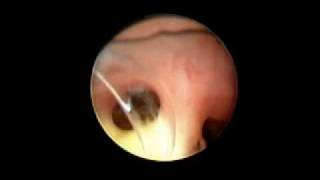 Tracheoscopy Falcon Aspergillosis [upl. by Adali934]