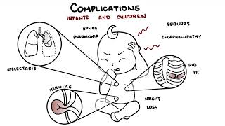 What is Pertussis and whooping cough  Bordetella pertussis symptoms pathophysiology and treatment [upl. by Finah]