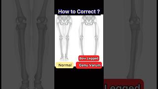 Bow Legs Correction Genu Varum Exercise [upl. by Aylatan]