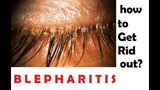 what is blepharitis How to get rid out of this hindi [upl. by Epillihp]