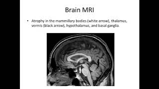 Korsakoff syndrome of psychiatric and alcoholic etiology  Video abstract ID 203513 [upl. by Eynttirb]