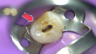 LIVE Root Canal Procedure under the Microscope w Specialist [upl. by Liane526]