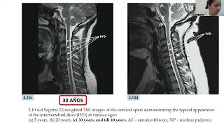 SPINE WEBINAR 64 DISCOPATIA CERVICAL INDICACIONES DE MALLAS DE EXPANSION VS CAJAS INTERSOMATICAS [upl. by Iretak]