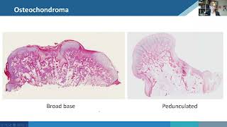 Chondrogenic tumors of bone [upl. by Hi226]