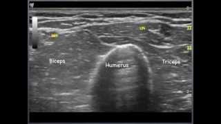 Ulnar Nerve  humerus to elbow Sonoanatomy  QMH AED Ultrasound Casebook 2013 Video 8 [upl. by Eiramlirpa]