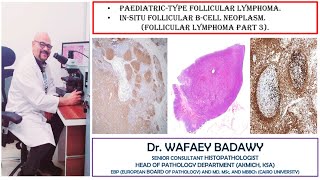 PAEDIATRIC TYPE FOLLICULAR LYMPHOMA AND IN SITU FOLLICULAR B CELL NEOPLASM BY DR WAFAEY BADAWY [upl. by Ron]