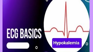 ECG changes in Hypokalemia Causes of Hypokalemia [upl. by Giffard]