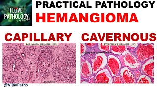 HEMANGIOMA capillary amp Cavernous Clinical features amp Morphology [upl. by Ahrens]