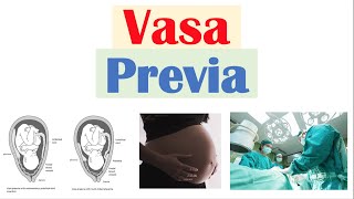 Vasa Previa Obstetrical Condition  Causes Risk Factors Signs amp Symptoms Diagnosis Treatment [upl. by Lyrej]