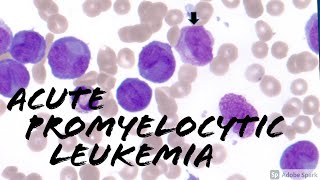 Acute Promyelocytic Leukemia APL microgranular vs classic cottage loaf cells Hematology [upl. by Yatnohs]