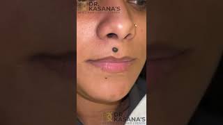 Mole Removal EXPERT Shares Top Secrets  DrLalit Kasanas [upl. by Adnawat]