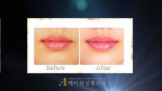 KOREA Mouth corner lift before amp after plastic surgery [upl. by Stefan150]