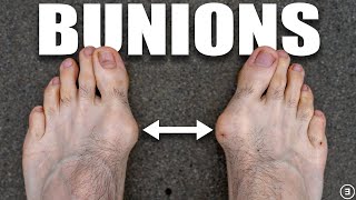 Bunions  Hallux Valgus Diagnosis Exercises Treatment [upl. by Marzi]