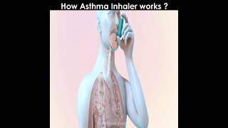 How asthma inhaler works [upl. by Leva]