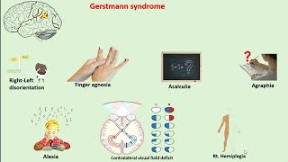 Gerstmann syndrome  Alexia with Agraphia  angular gyrus [upl. by Eisserc]