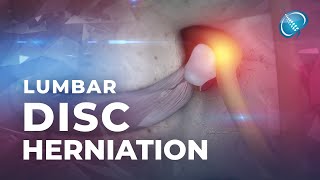 Herniated Disc  Patient Education [upl. by Butler359]