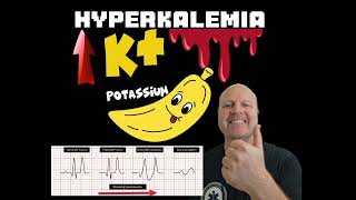 Why Hyperkalemia causes a widened QRS complex on the ECG  Explained [upl. by Adnilam]