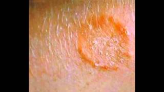 Skin Fungus Signs Symptoms Treatment HD [upl. by Demmahom515]