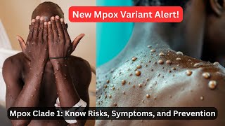 Mpox VARIANT ALERT What You Need to Know About Clade 1 Risks and Prevention [upl. by Cathyleen]