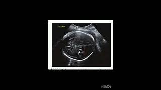 ULTRASOUND OF FETAL HEAD ANOMALIES REVIEW OF CHAP 15 FROM THE BOOK REQUISITES OF ULTRASOUND [upl. by Enawyd596]