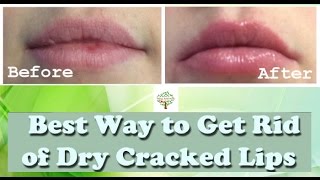 Cracked Lips  Dry Lips  Natural Ayurvedic Home remedies [upl. by Elleirad]