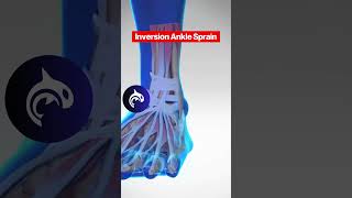 See the difference between both Eversion and Inversion Ankle Sprains in 3D Animation [upl. by Nnylahs]