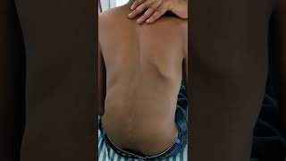 Kyphoscoliosis in a Case of Marfans Syndrome [upl. by Delogu]